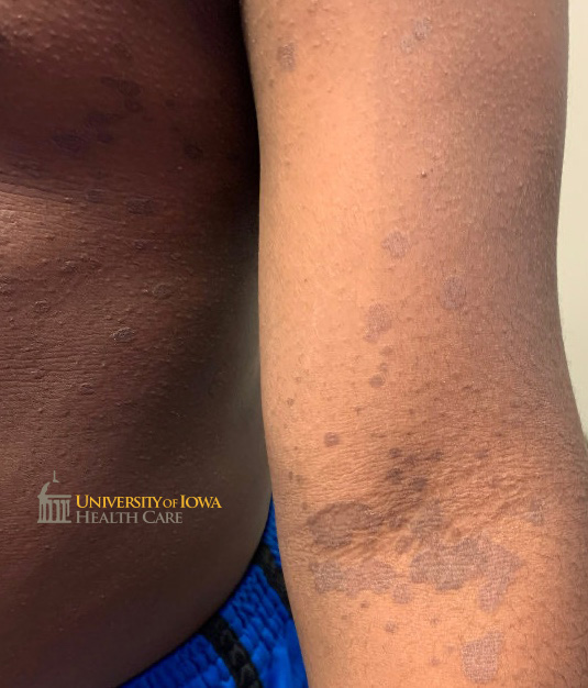 Gray-brown scaly annular plaques and papules on the trunk and extremity. (click images for higher resolution).